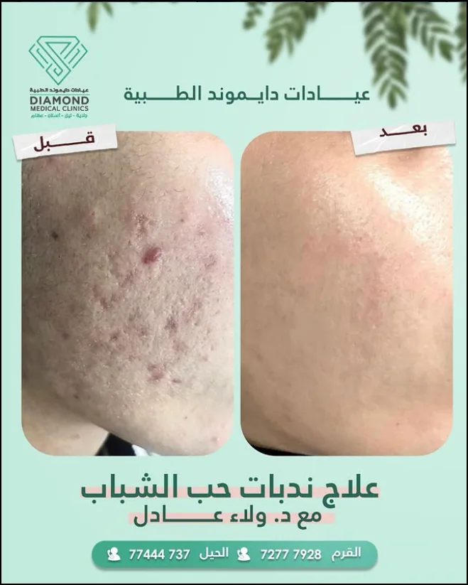 علاج ندبات البشرة — توازن أنعم للبشرة