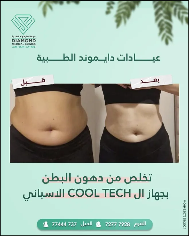 نحت القوام — قوام أكثر تحديداً