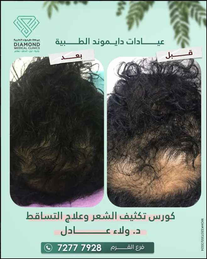 علاج الشعر — كثافة وخط شعر طبيعي