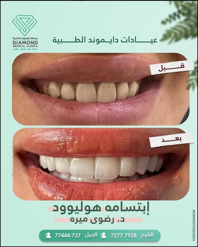ابتسامة هوليوود — تصميم ابتسامة متكامل