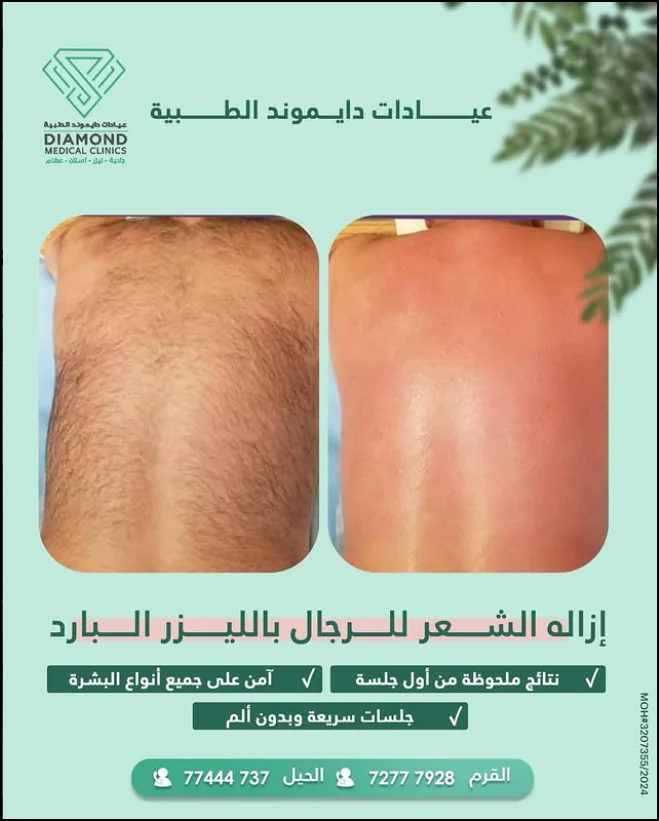 إزالة الشعر بالليزر — بشرة أنعم للرجال