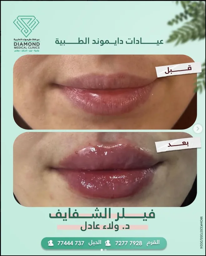 فيلر الشفاه — توازن طبيعي للشفاه