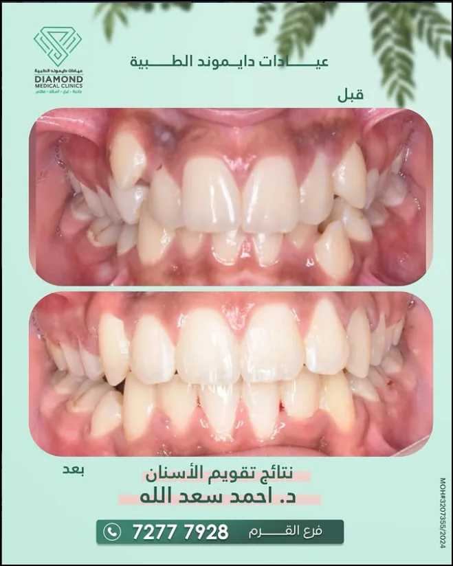 تقويم الأسنان — اصطفاف أدق للابتسامة