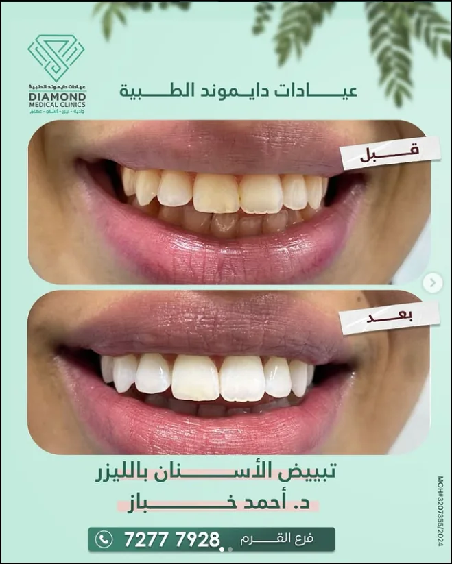 تبييض الأسنان — ابتسامة أكثر إشراقاً