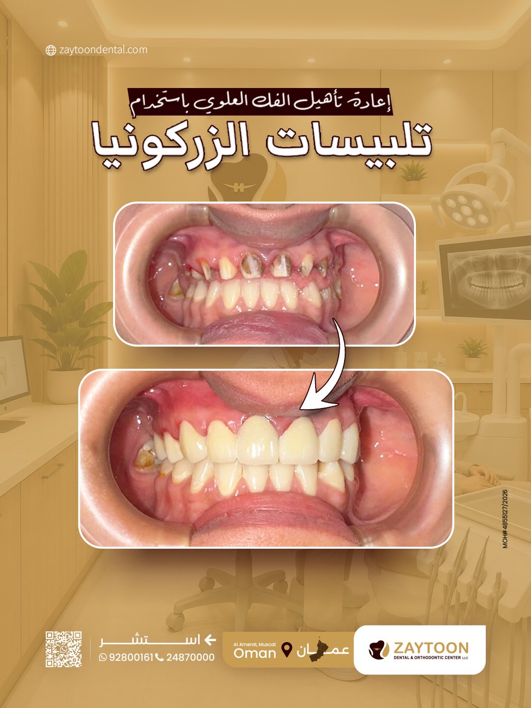 تلبيسات الزركونيا