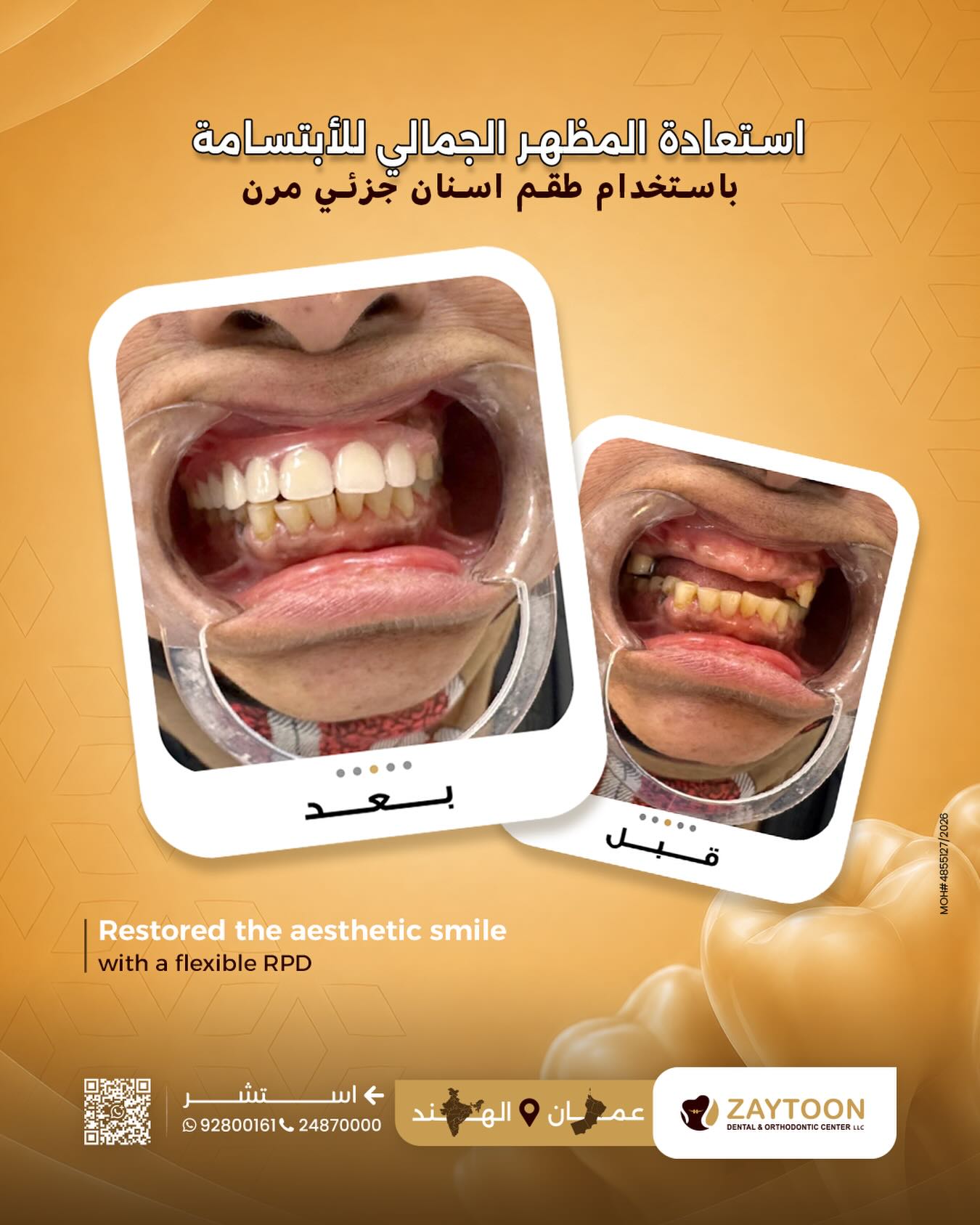 تعويض الأسنان المفقودة