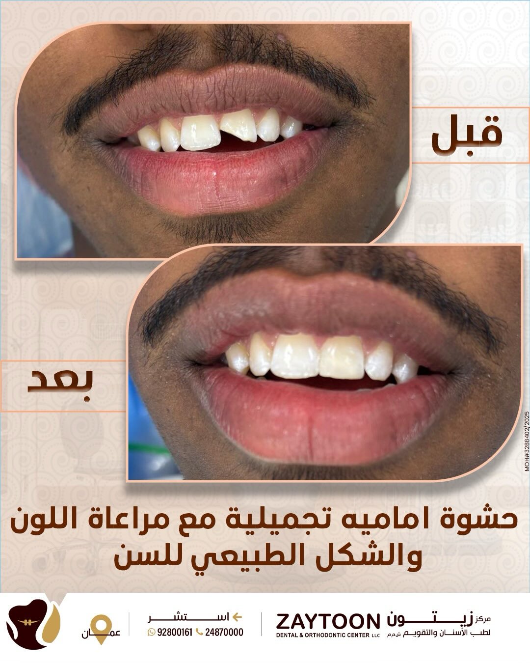 ترميم تجميلي أمامي