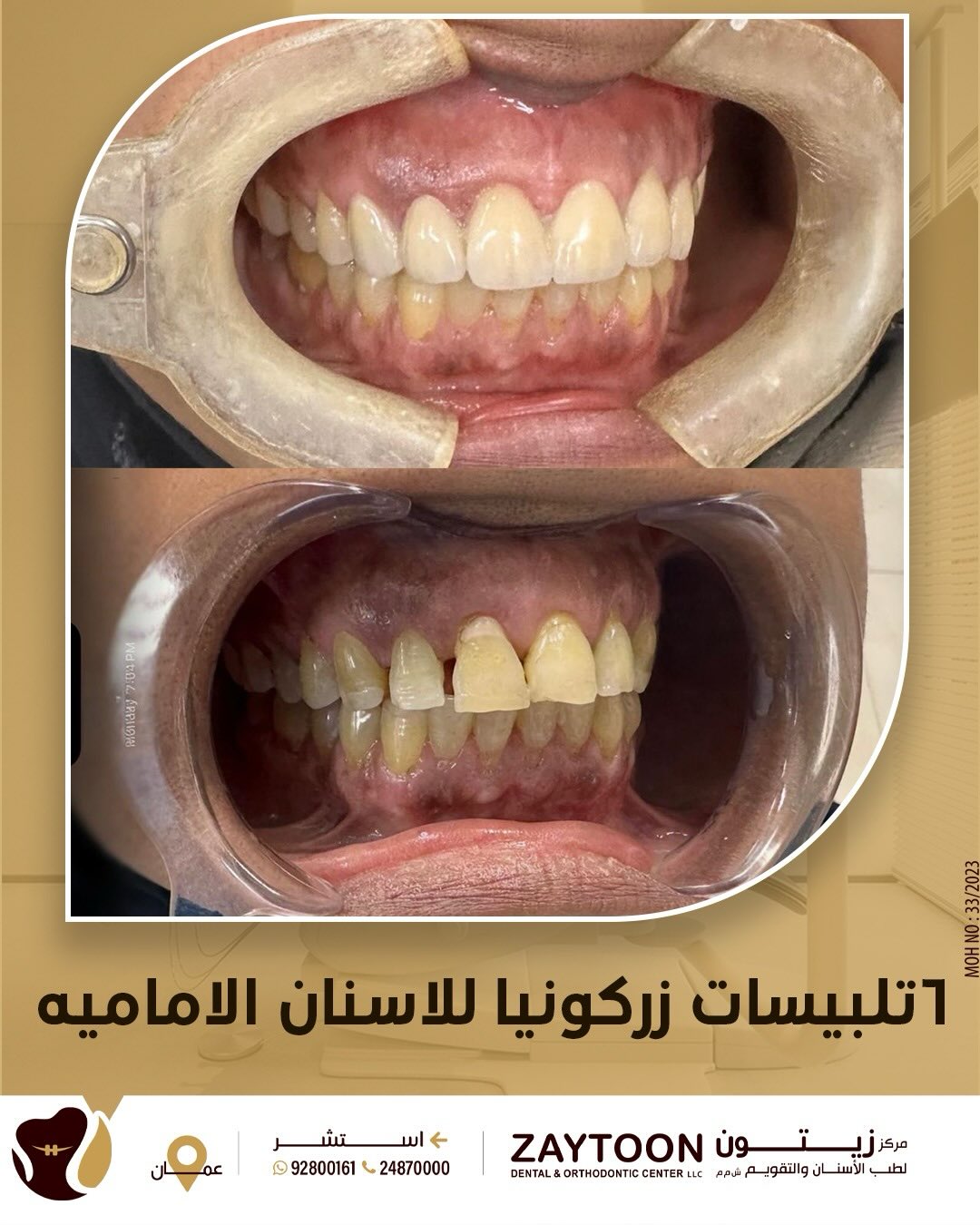 تلبيسات الأسنان الأمامية