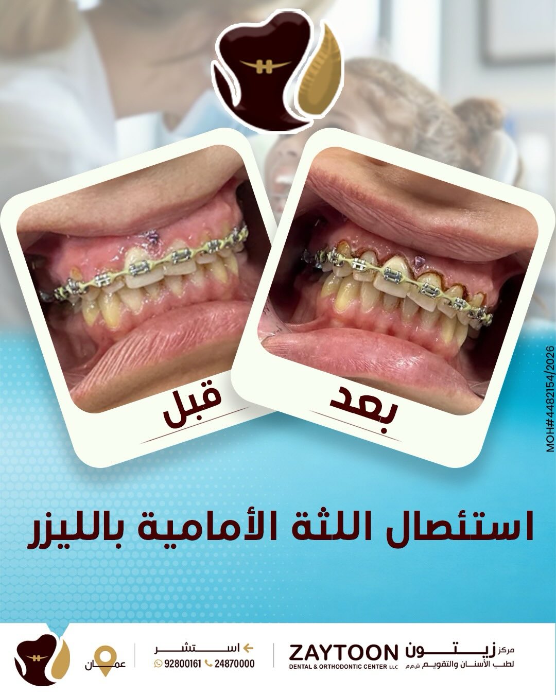 تجميل اللثة بالليزر