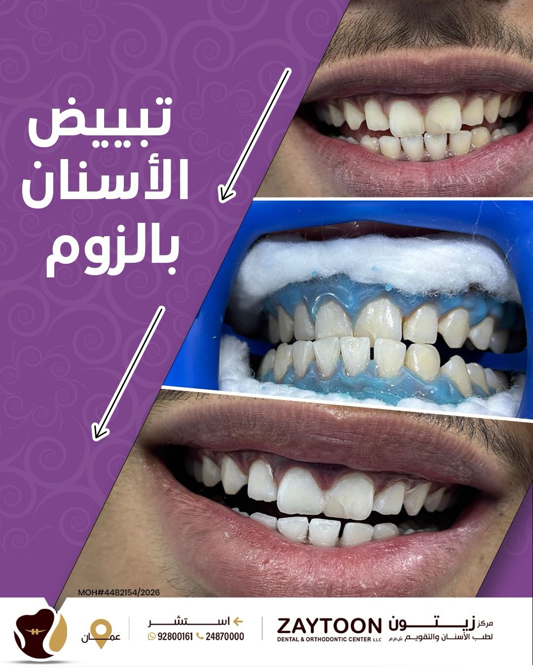تبييض الأسنان بتقنية Zoom
